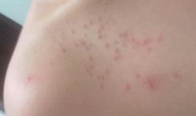 北京萬達行姜洪濤醫(yī)生最新開眼角效果分享！2023年價格公布！