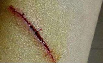 長(zhǎng)沙治療內(nèi)眼角問(wèn)題哪家醫(yī)院靠譜？這些醫(yī)療機(jī)構(gòu)備受推崇