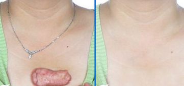 南京施爾美孫欣醫(yī)生 眼睛疾病治療90天真實(shí)案例分享