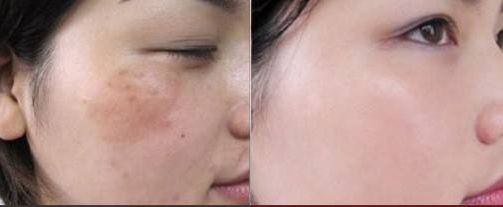 深圳陳星光醫(yī)生分享如何進(jìn)行胸部豐滿整形