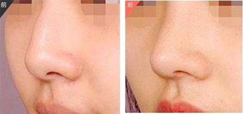 田孝臣醫(yī)生的鼻部整形效果如何？價格如何？技術(shù)評價+成功案例解析