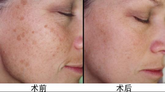 合肥有哪些醫(yī)院是治療祛斑效果明顯的？