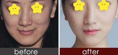 有效消腫的雙眼皮修復(fù)技巧由經(jīng)驗豐富的整形醫(yī)生分享