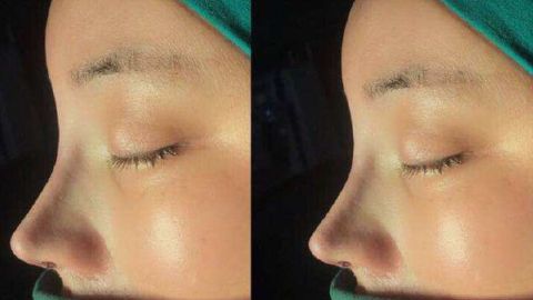 最佳2023西安雙眼皮修復(fù)醫(yī)生推薦！宋保強(qiáng)、馬顯杰好評(píng)如潮，立即預(yù)約！