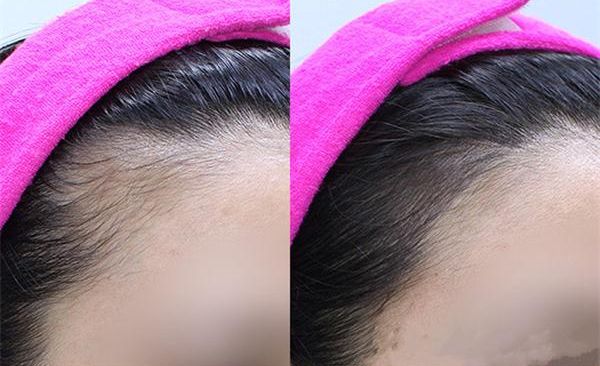 鄭州哪家醫(yī)院擅長(zhǎng)祛斑，技術(shù)精湛值得推薦！