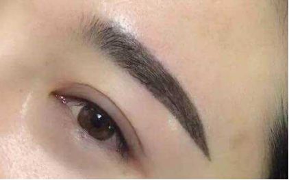 眼瞼下垂的不同類型及修復(fù)建議分享