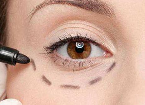 唐山優(yōu)秀雙眼皮修復醫(yī)生口碑盤點，案例分析、價格透明