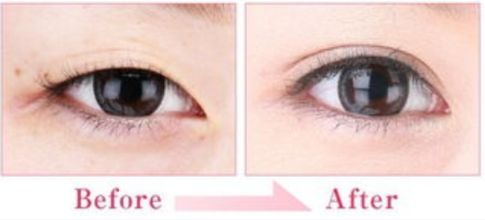 合肥哪家醫(yī)院的隆鼻效果好？技術過硬嗎？