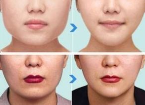 武漢脫毛術(shù)的選擇：哪家醫(yī)院更靠譜？市第五醫(yī)院、美基元脫毛技術(shù)備受推崇！