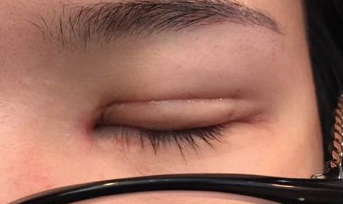 揭秘車紅昌教授的雙眼皮手術及成功案例分享