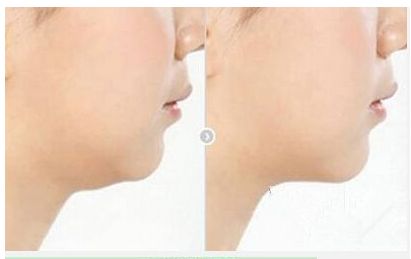 高偉的頜骨修復(fù)費用及綜合實力揭秘，醫(yī)生專業(yè)解讀技術(shù)及真實案例分享