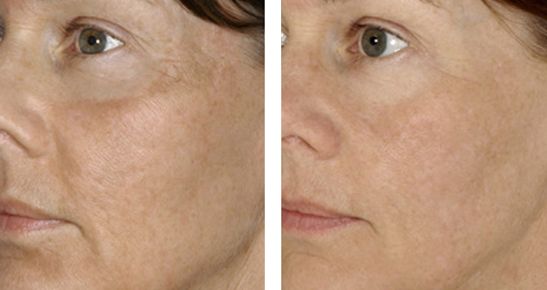 北京下頜角修復專家推薦，張笑天助您實現(xiàn)理想瘦臉！