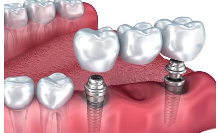 廣州華美高順福鼻修復帶來的革命性體驗案例揭秘