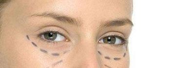 重慶德龍整形醫(yī)院推出先進(jìn)技術(shù)，助您實(shí)現(xiàn)完美雙眼皮!