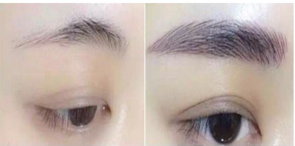 專家為您解答：涿州市哪家醫(yī)院可進(jìn)行瘦臉針治療？費(fèi)用如何？醫(yī)師推薦為參考