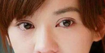 探索成都圣丹福整形醫(yī)院的雙眼皮修復(fù)成果，經(jīng)驗(yàn)分享