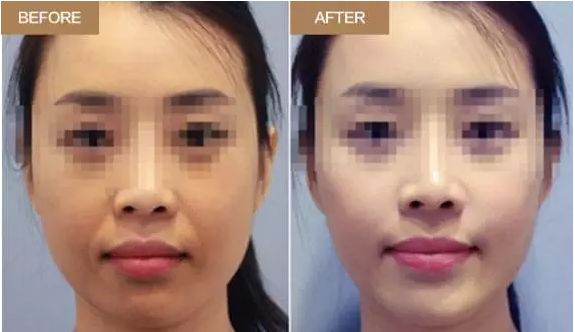 廣州哪家醫(yī)院鼻修復(fù)效果突出？這些醫(yī)院實力不可小覷！