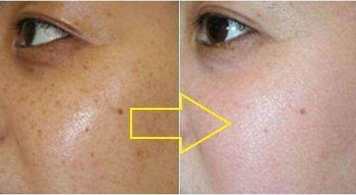 杭州哪家醫(yī)院是比較好的隆鼻選擇？