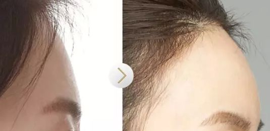 廣州顏玲診所最新出爐吸脂技術(shù)效果如何？該醫(yī)院案例曝光