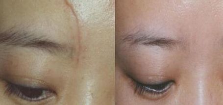 杭州一位醫(yī)生的雙眼皮手術(shù)實(shí)踐分享，持續(xù)80天的親身經(jīng)歷！