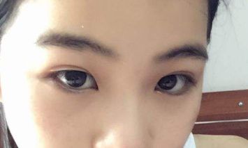 北京知音吸脂醫(yī)生分享大腿吸脂案例，想了解吸脂效果的朋友必看