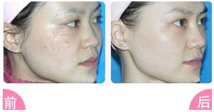 榆林二院整形科值得信賴嗎？醫(yī)生專業(yè)，雙眼皮案例豐富，收費明明白白，專家指南！