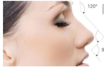 無錫二院隆鼻效果及費(fèi)用情況詳解，醫(yī)生分享成功案例