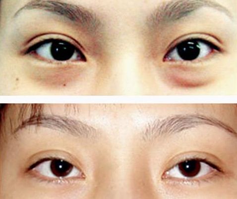 謝錦清：醫(yī)術高超，雙眼皮案例解析曝光！