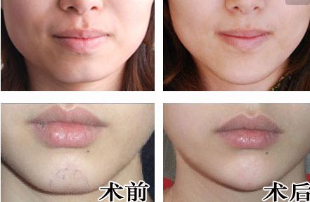 廣州人中縮短手術(shù)醫(yī)生推薦？網(wǎng)友真實評價與信息公開！