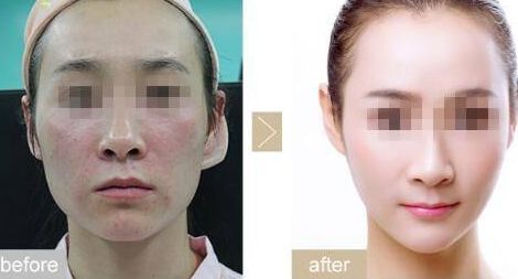 曲靖哪家醫(yī)院能做黃金微針效果好