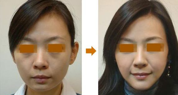 北京哪家鼻整形醫(yī)院評價好