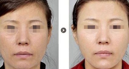 烏魯木齊哪里可以做雙眼皮手術？選擇哪家醫(yī)院效果好？