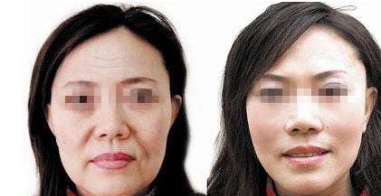 成都自然雙眼皮去哪家醫(yī)院靠譜？