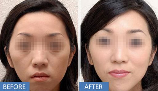 上海哪家醫(yī)院做打玻尿酸除皺效果好？