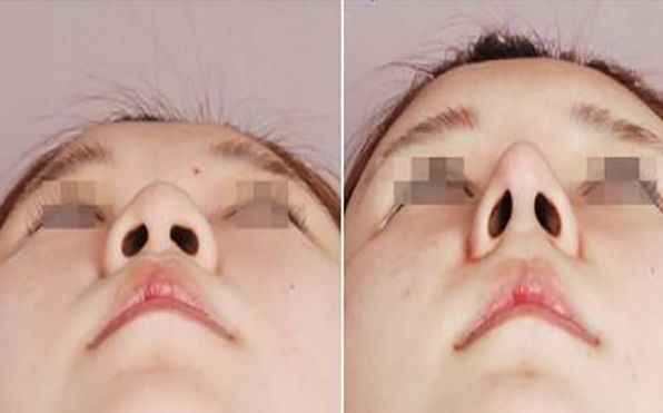 中國吸脂手術(shù)，選擇哪家醫(yī)院更合適？