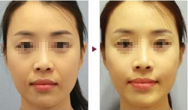 無錫搶手：受歡迎的雙眼皮整形醫(yī)院TOP10