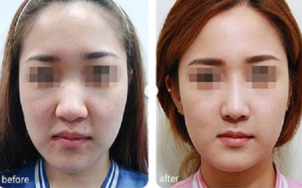 珠海市三家最受歡迎的隆鼻整形醫(yī)院及排名+推薦