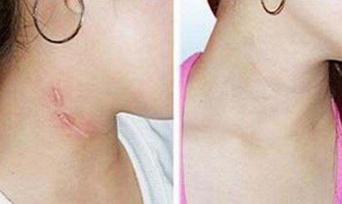 昆明近視手術(shù)醫(yī)院推薦及費用指南