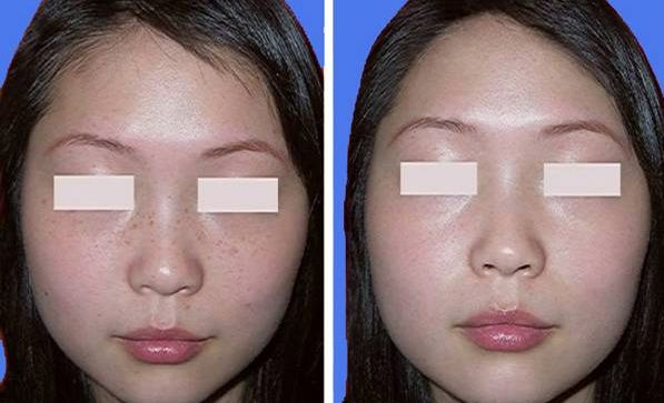 十堰太和醫(yī)院整形埋線雙眼皮手術(shù)案例展示及價(jià)格參考