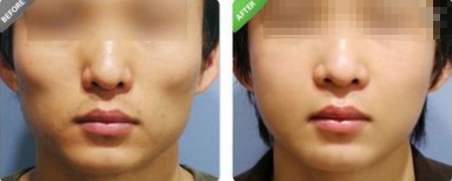 深圳哪家醫(yī)院的拉皮除皺效果最好？排名前幾位的醫(yī)院有哪些？