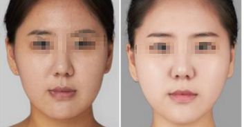 上海八院脂肪填充手術(shù)費如何？專家拆解詳情及特色優(yōu)勢