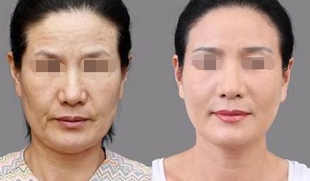 雍禾與碧蓮盛技術(shù)優(yōu)勢與收費(fèi)比較