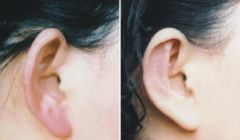 推薦：北京哪家隆鼻醫(yī)院口碑比較好？