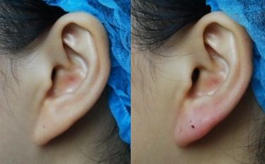 成都哪家醫(yī)院的埋線雙眼皮效果好？最新匯總