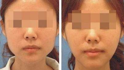 上海哪家醫(yī)院的下巴隆鼻手術(shù)效果最好？