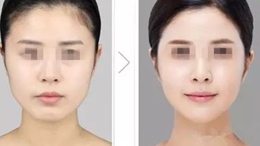 長(zhǎng)沙雙眼皮整形醫(yī)院推薦，哪家效果更好？