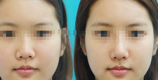 成都市吸脂手術(shù)在哪兒可以做？