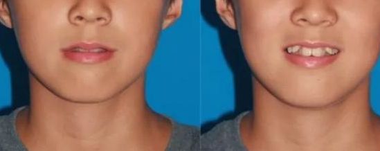 沈陽雙眼皮手術(shù)價(jià)格參考，名流、百嘉麗、杏林整形費(fèi)用更新【2024最新】