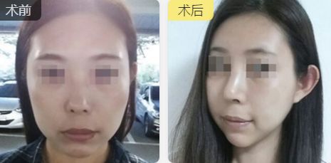 合肥雙眼皮整形推薦：口碑好、技術(shù)精湛、性?xún)r(jià)比高的醫(yī)生