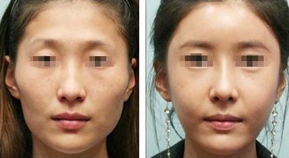 北京磨骨手術(shù)醫(yī)院排行榜